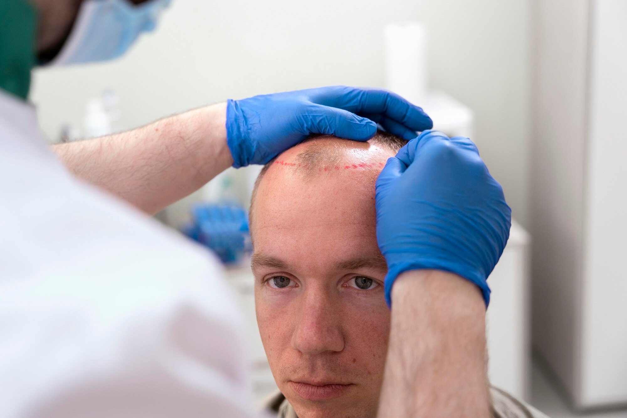 FUE (Follicular Unit Extraction)