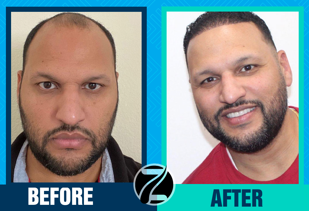 Before After 8