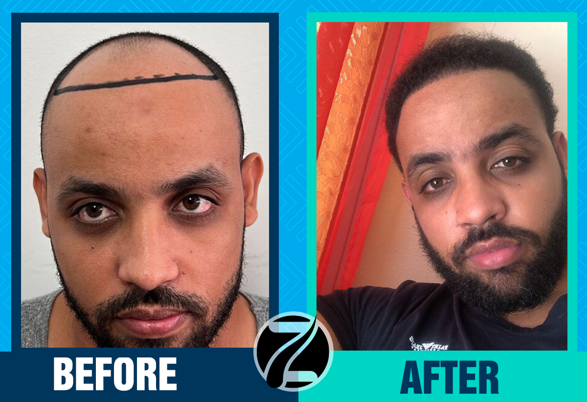 Before After 7