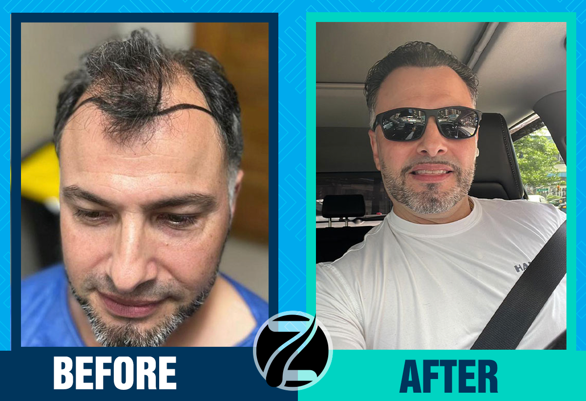 Before After 6