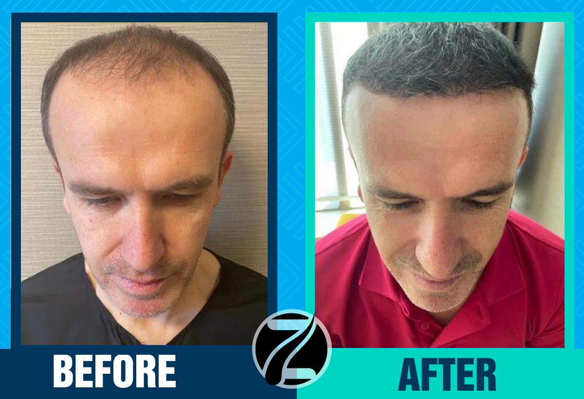 Before After 4