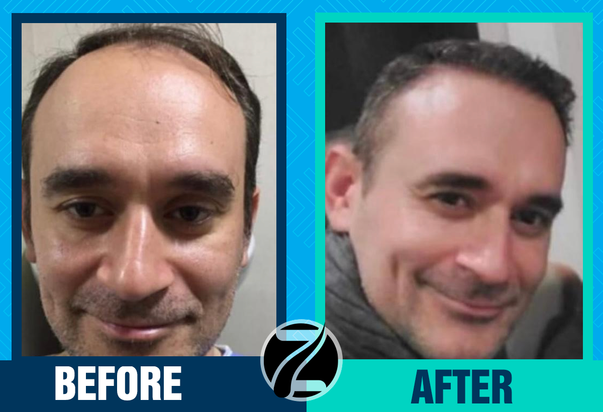 Before After 3
