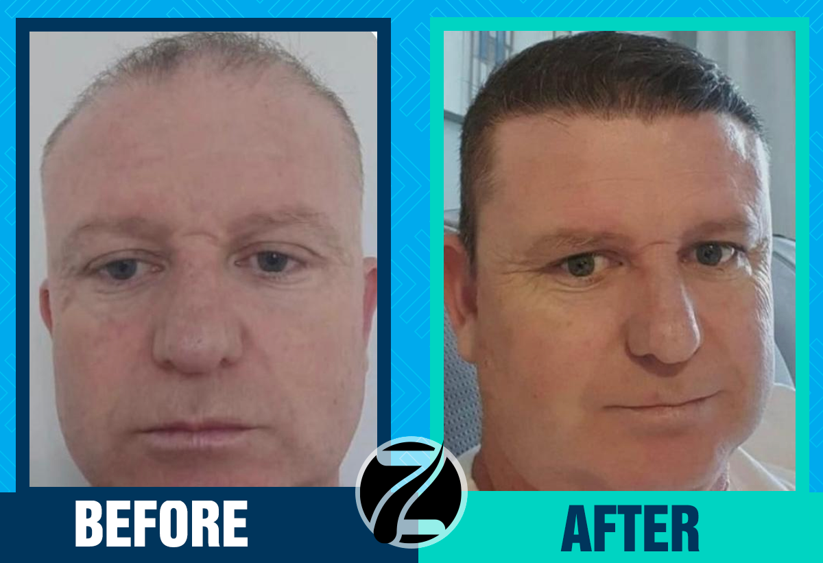 Before After 2