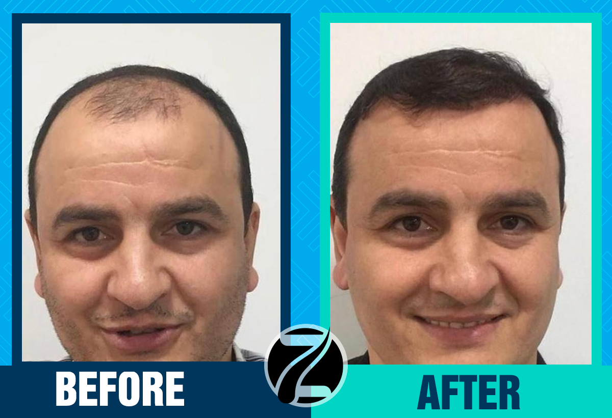 Before After 1